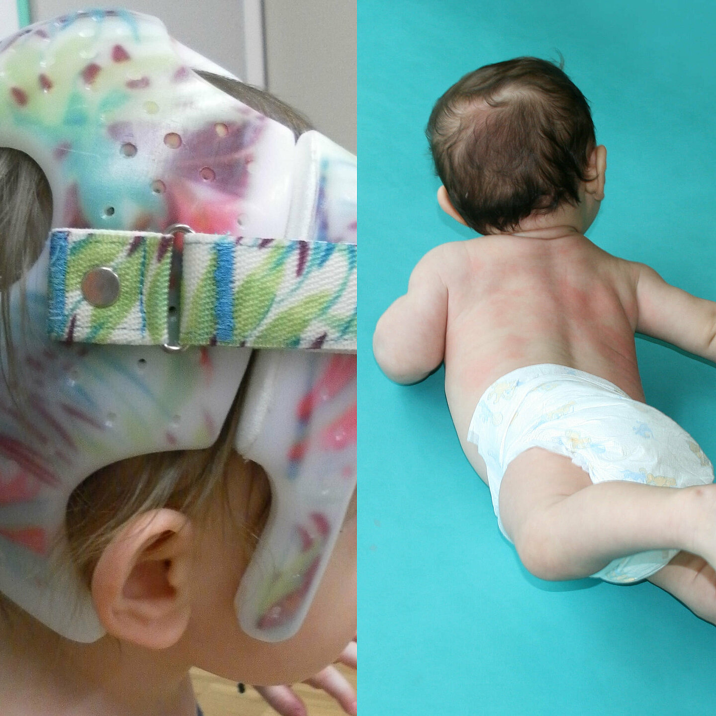 Kinder mit Schädelasymmetrie: Therapie mittels Kopfortthese