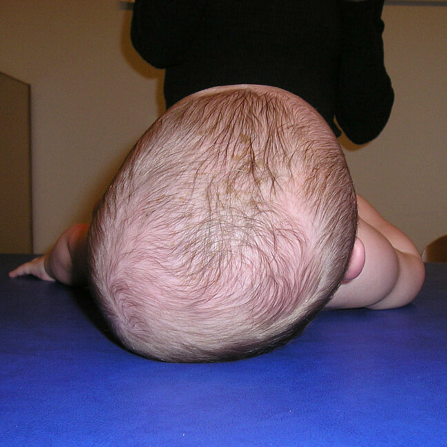 Baby mit asymmetrischer Kopfform